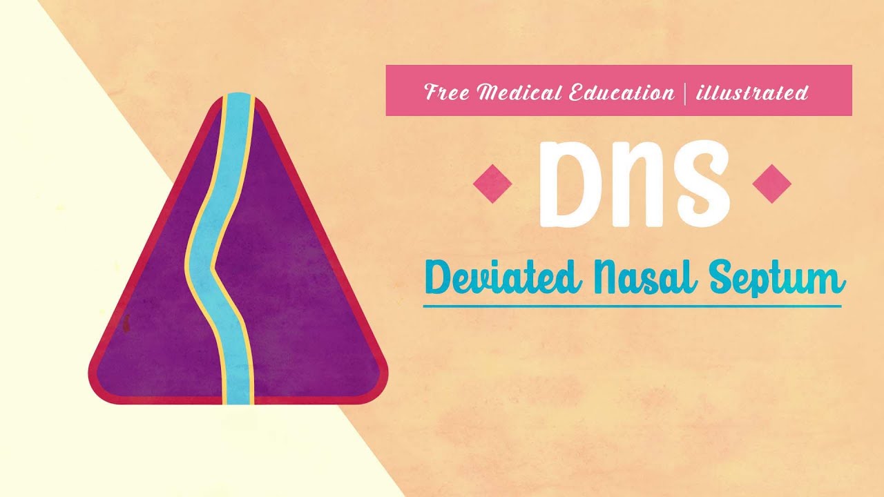 What is Deviated Nasal Septum (DNS)?