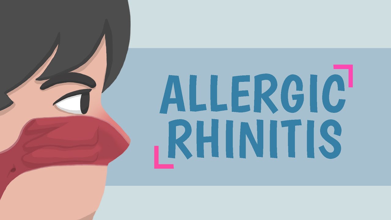 What is Allergic Rhinitis?