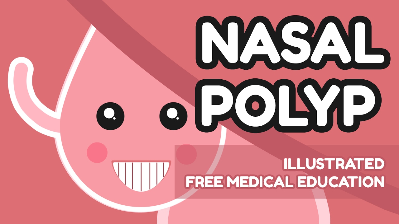 What is Nasal Polyp?