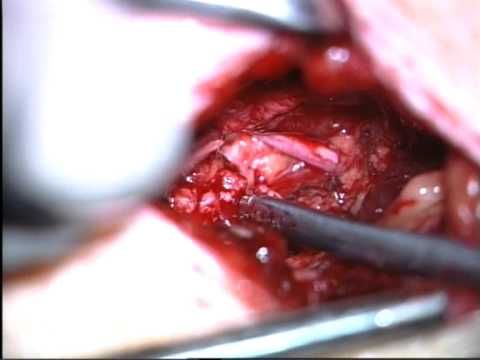Hernia Spine surgery L5-S1