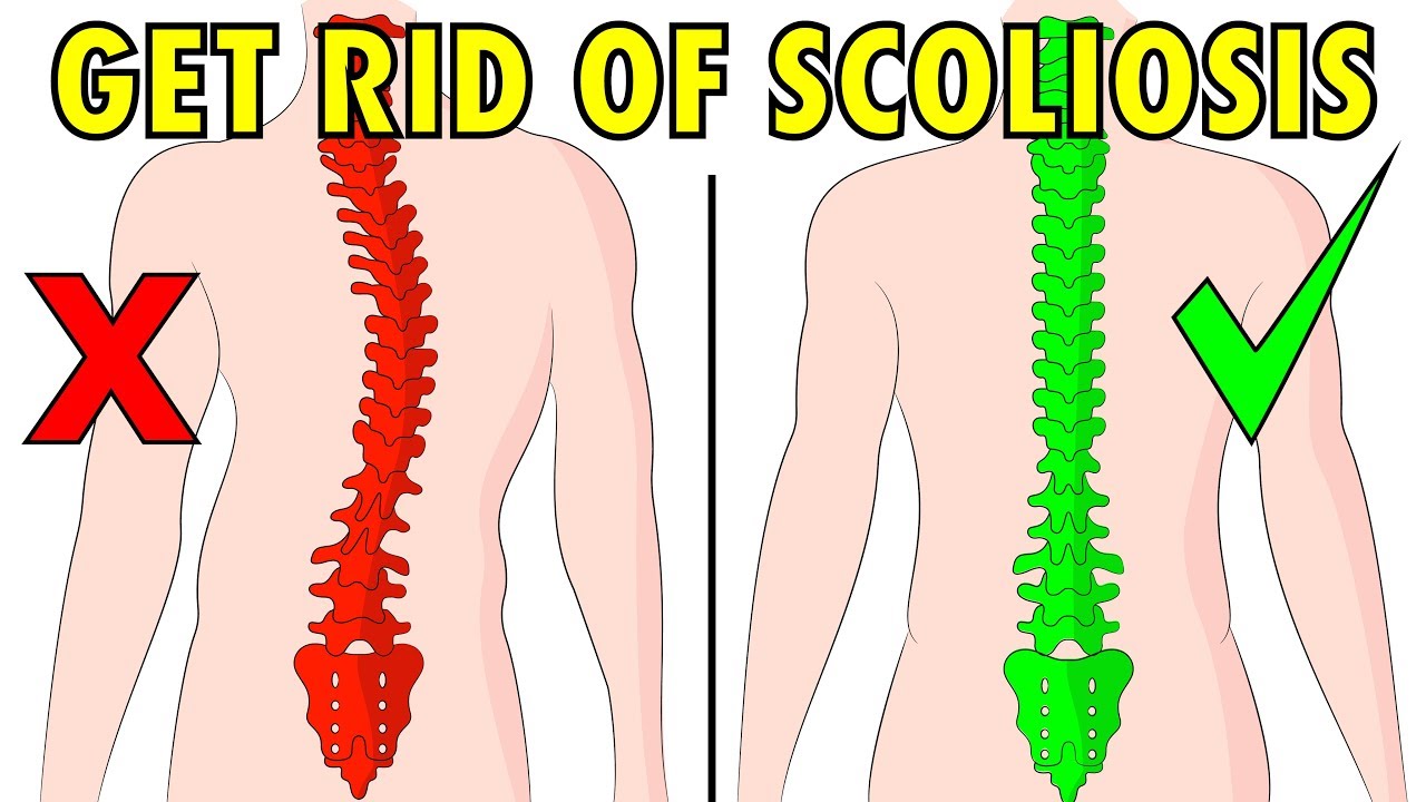 How to fix scoliosis naturally in 4 minutes a day