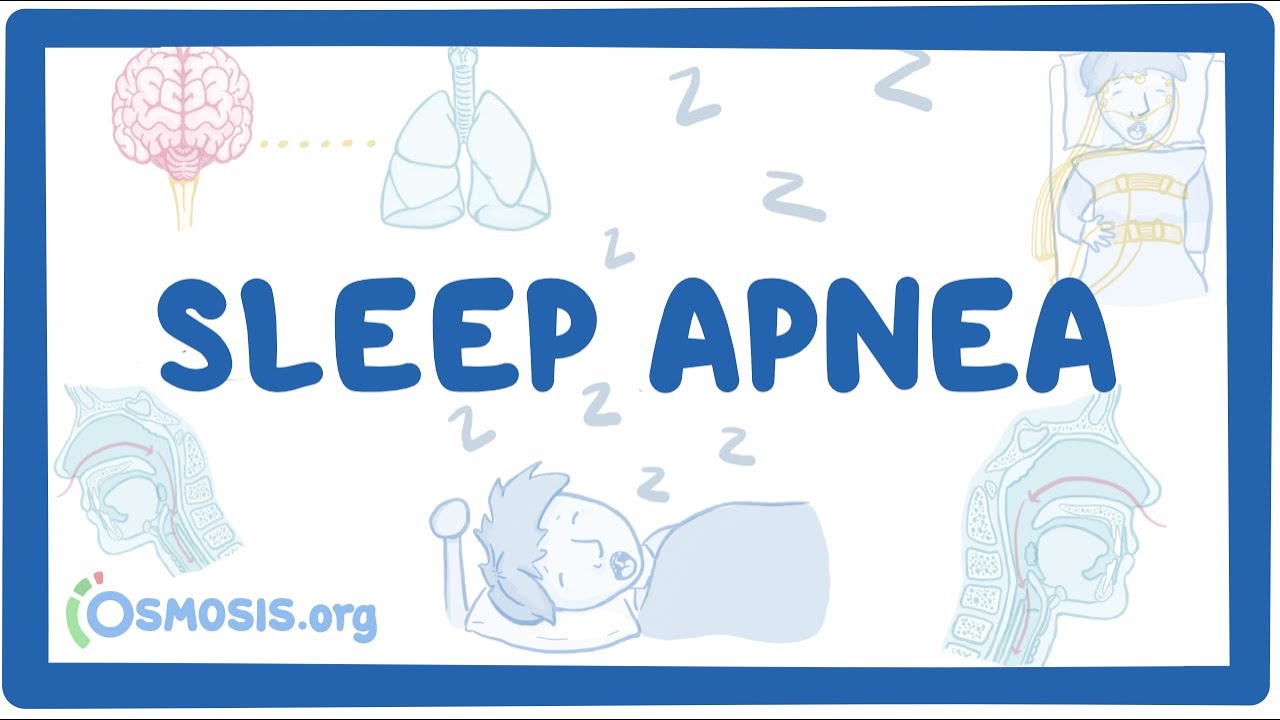 Sleep apnea - causes, symptoms, diagnosis, treatment, pathology