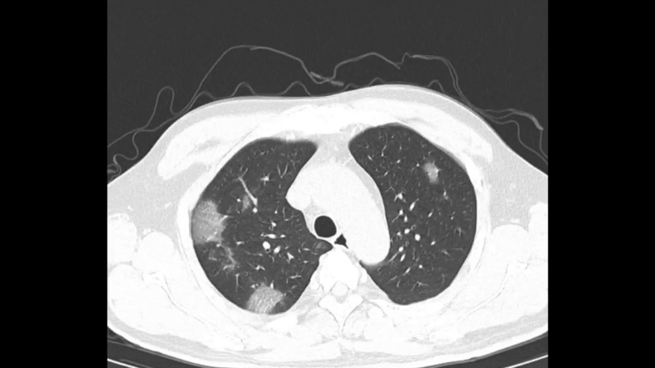 Chest CT findings in COVID-19